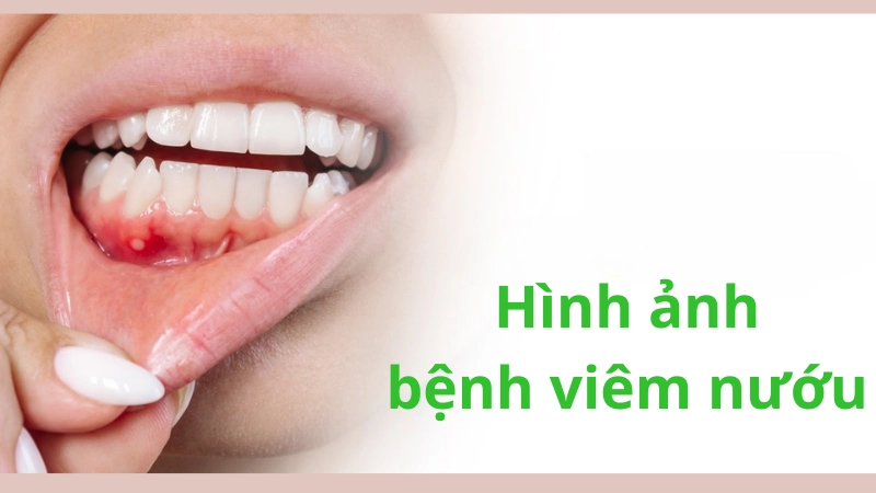Hình ảnh bệnh viêm nướu chi tiết giúp nhận biết sớm