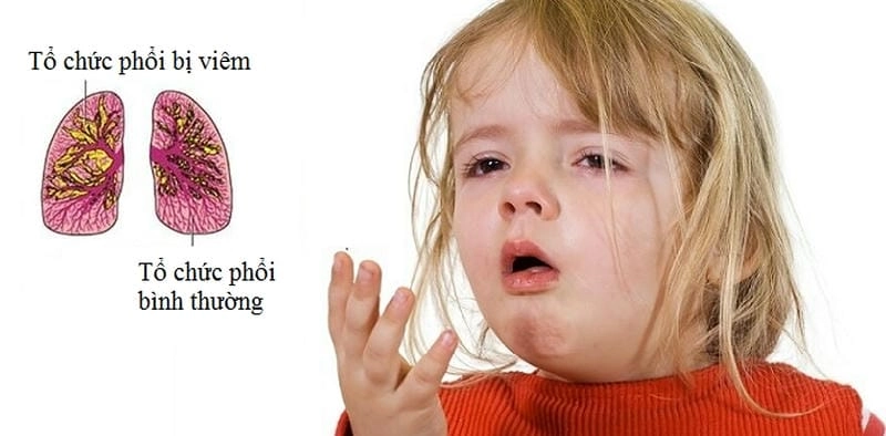 Hiểu đúng các dấu hiệu của trẻ bị viêm phổi