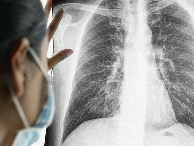 Khám phá hình ảnh bệnh viêm phổi rõ nét