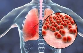 Khám phá thực tế hình ảnh viêm phổi ở người lớn