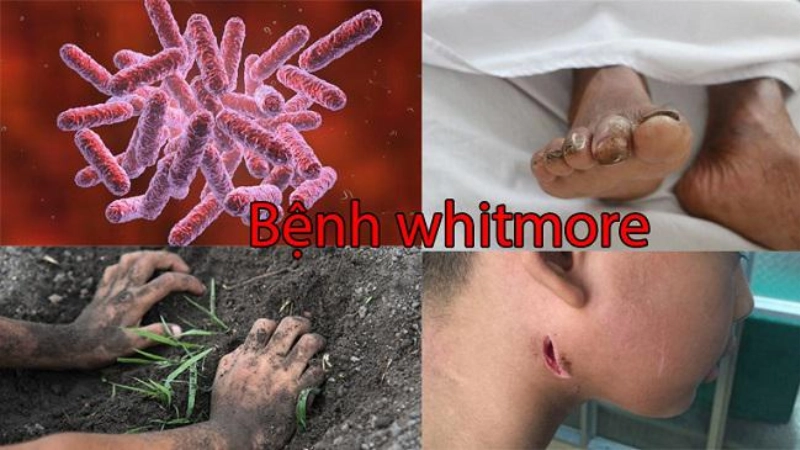Phân biệt hình ảnh bệnh Whitmore với bệnh ngoài da