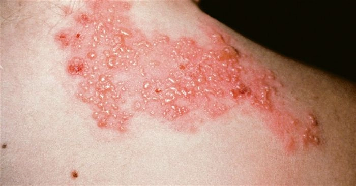 So sánh mức độ nặng nhẹ với hình ảnh người bị zona