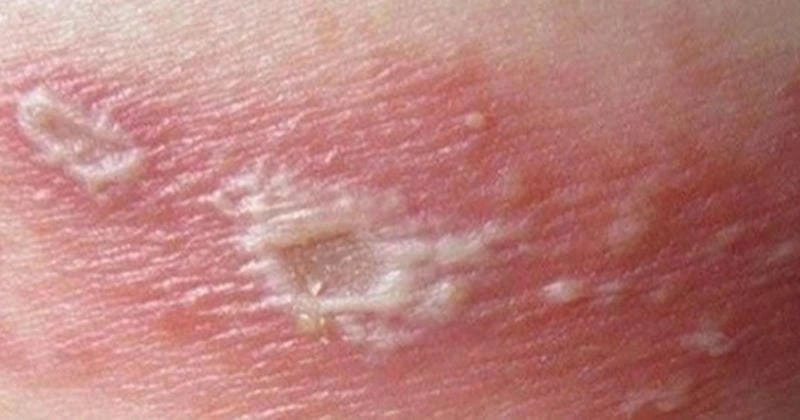 Cách điều trị hiệu quả với hinh anh zona than kinh