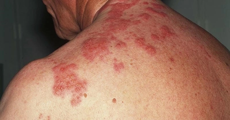 Nhận biết sớm các dấu hiệu qua hinh anh zona