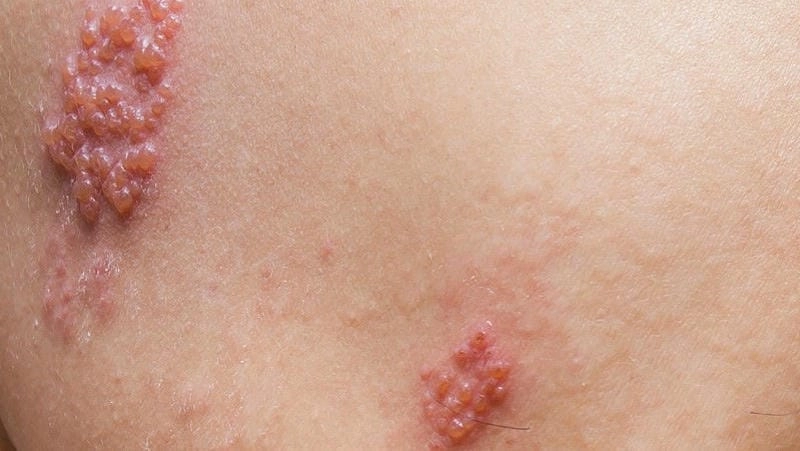 Mô tả vết phồng rộp chi tiết trong ảnh bệnh zona