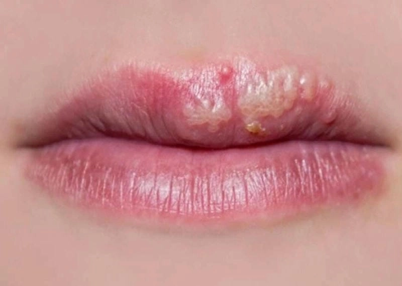 Thuốc bôi zona môi giúp giảm đau giảm ngứa