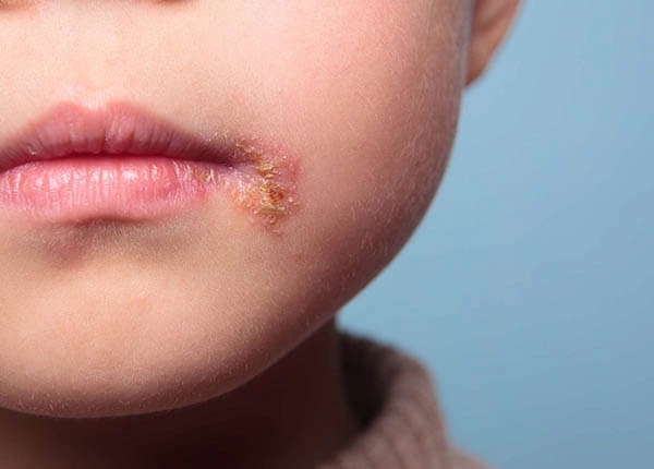 Bệnh zona ở môi có thể lây lan nhanh