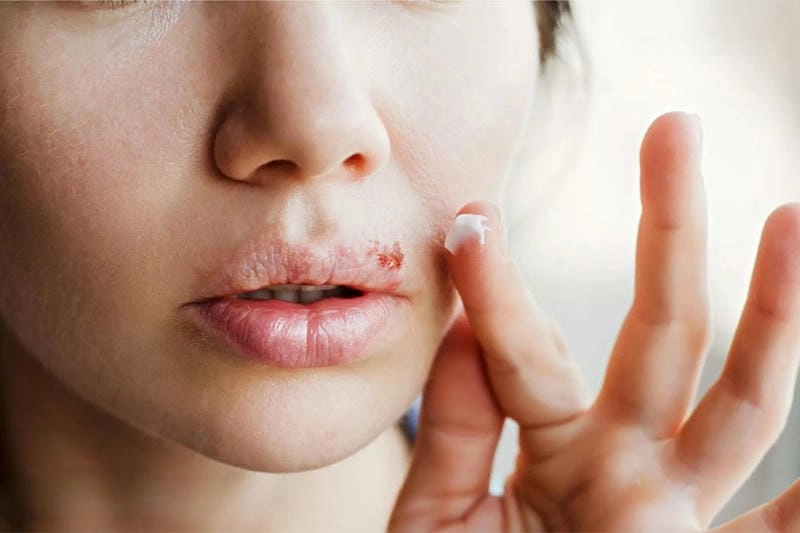Trị zona ở môi cần kết hợp cả uống và bôi