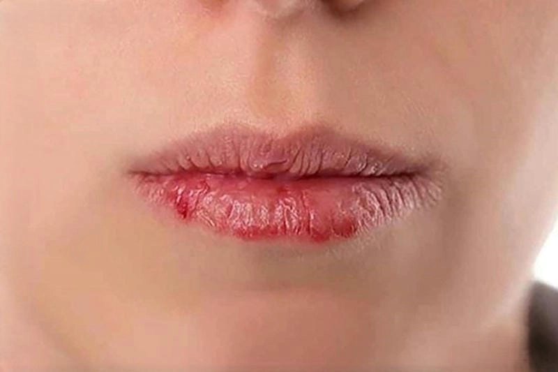 Trị zona ở môi cần kết hợp cả uống và bôi