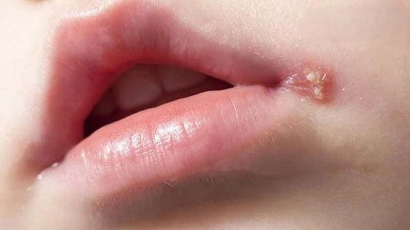 Zona môi thường tái phát nếu sức đề kháng yếu