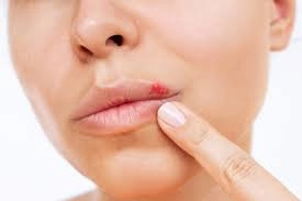 Bị zona môi cần chữa sớm tránh để lại sẹo