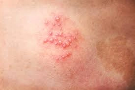 Nhận biết nhanh qua hình ảnh bị bệnh zona ở trẻ rõ ràng