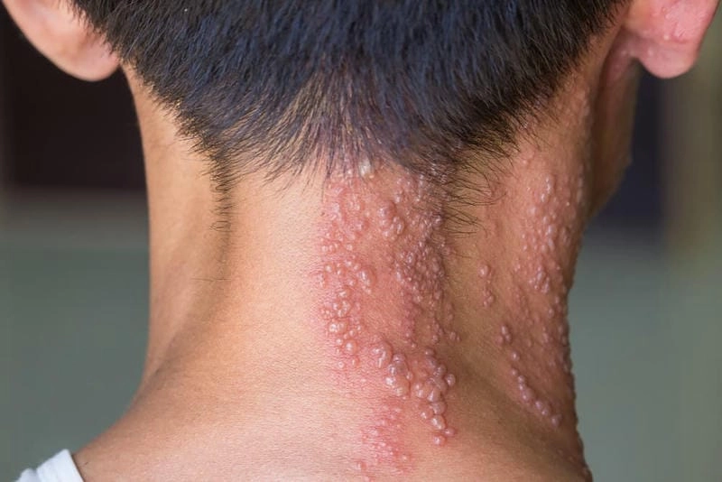 Hình minh họa thực tế trẻ em bị zona cần biết