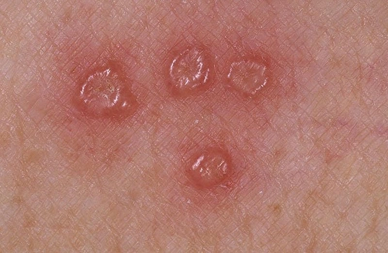 Tìm hiểu dấu hiệu từ ảnh benh zona o tre em cụ thể