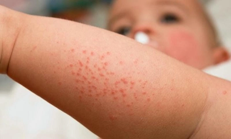 Phát hiện sớm triệu chứng bị zona ở trẻ em qua hình