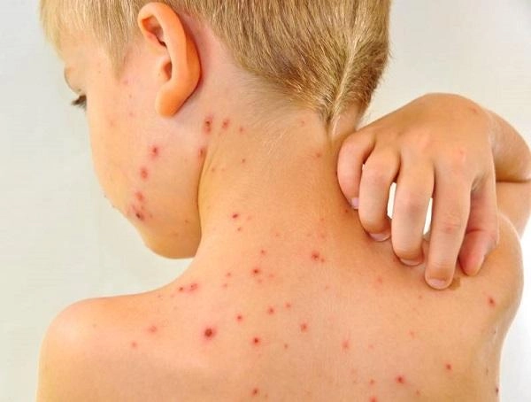 Hình ảnh giúp nhận diện sớm zona ở trẻ nhỏ hiệu quả