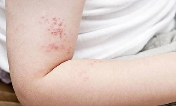 Tìm hiểu dấu hiệu từ ảnh zona trẻ nhỏ phổ biến