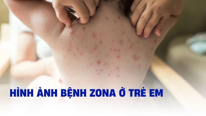 Cập nhật hình ảnh bệnh zona ở trẻ em mới nhất hiện nay
