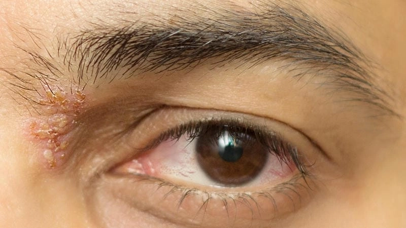 Hình ảnh bệnh zona thần kinh ở mắt và thần kinh zona ở mắt