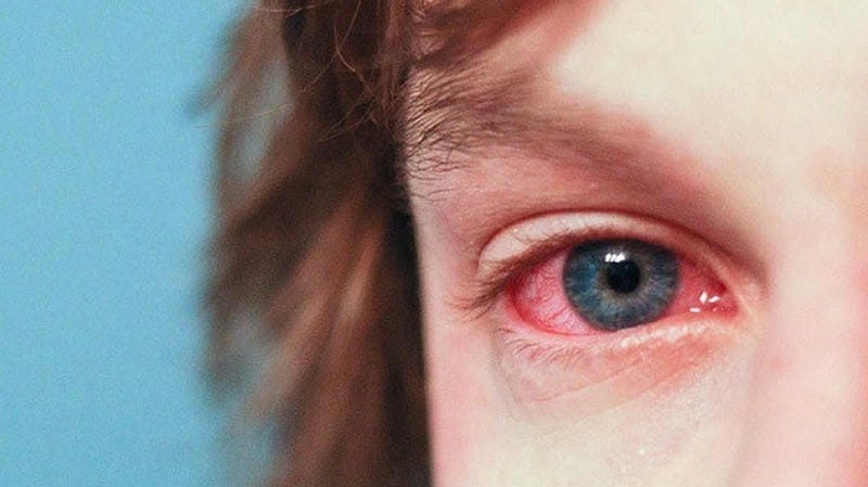 Bộ sưu tập hình ảnh zona ở mắt từ hình ảnh bệnh zona thần kinh ở mắt