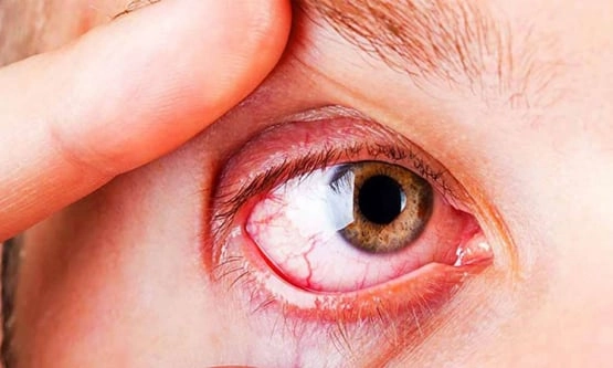 Tìm hiểu zona ở mắt có lây không từ hình ảnh bệnh zona thần kinh ở mắt