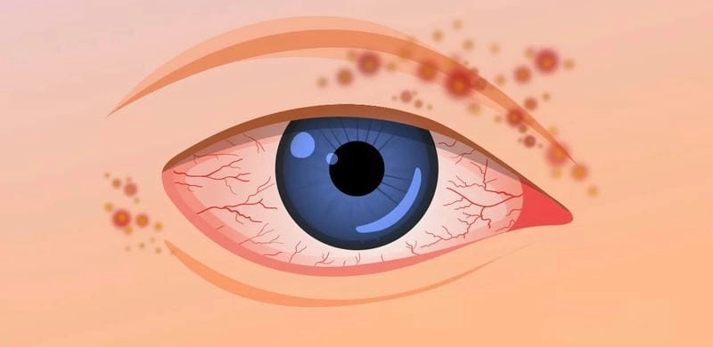 Khi mắt bị zona hãy tham khảo hình ảnh bệnh zona thần kinh ở mắt