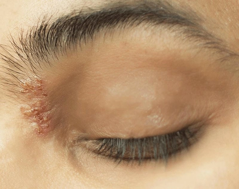 Xem rõ triệu chứng zona ở mắt qua hình ảnh bệnh zona thần kinh ở mắt