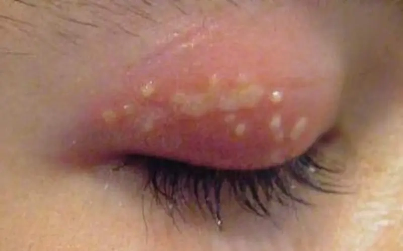 Cảnh báo zona vùng mắt với hình ảnh bệnh zona thần kinh ở mắt