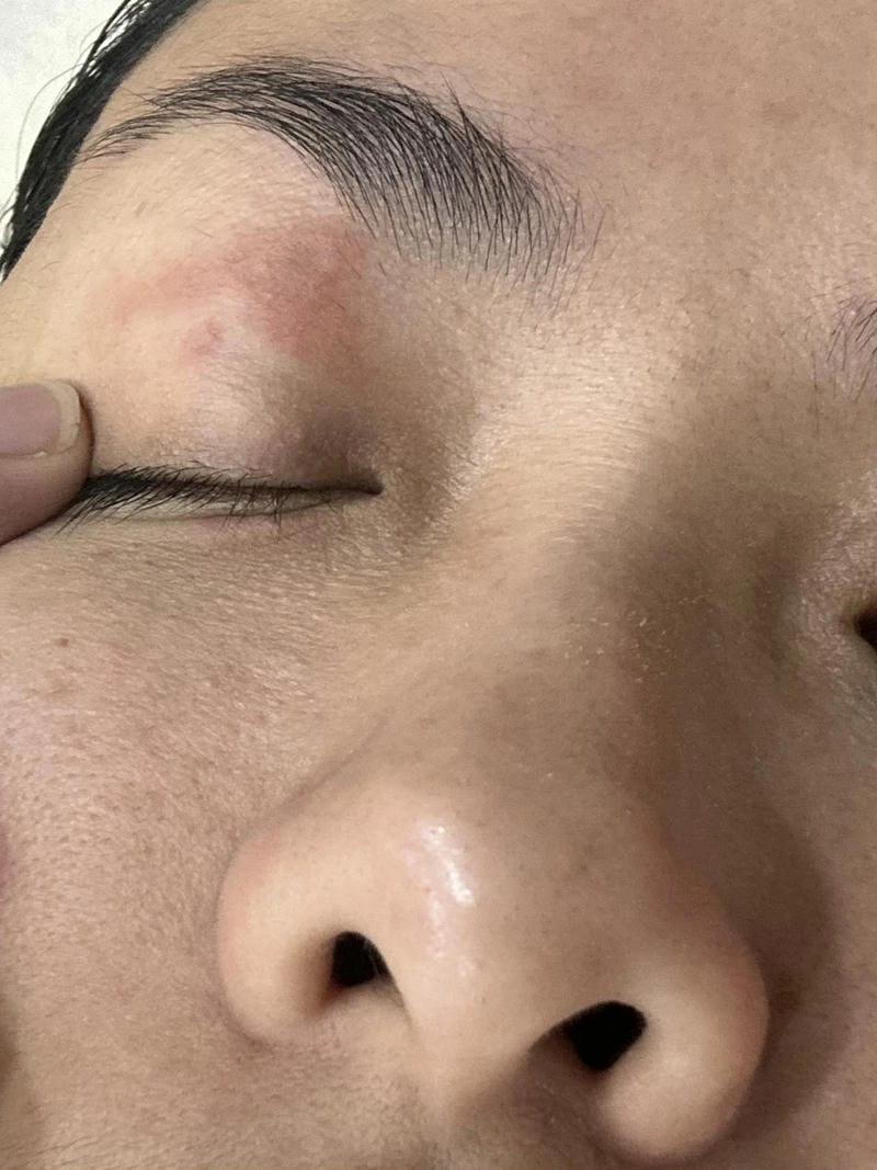 Tổng hợp zona quanh mắt từ hình ảnh bệnh zona thần kinh ở mắt