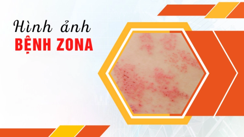 Cẩm nang nhận biết qua hình ảnh bệnh zona chi tiết nhất