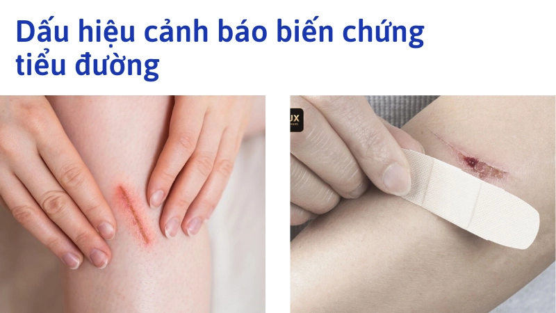 Vết thương lâu lành cảnh báo biến chứng bệnh tiểu đường