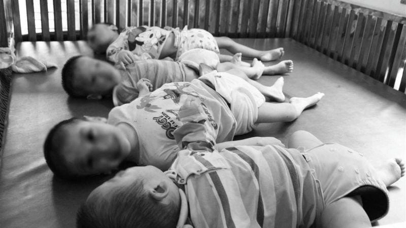 Ảnh chân tay bị bại liệt do biến chứng thần kinh