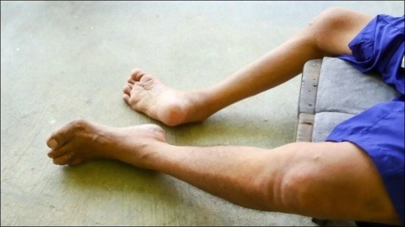 Ảnh thực tế bệnh nhân bại liệt trong quá trình điều trị