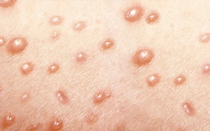 Bệnh zona ở trẻ em không nên xem nhẹ