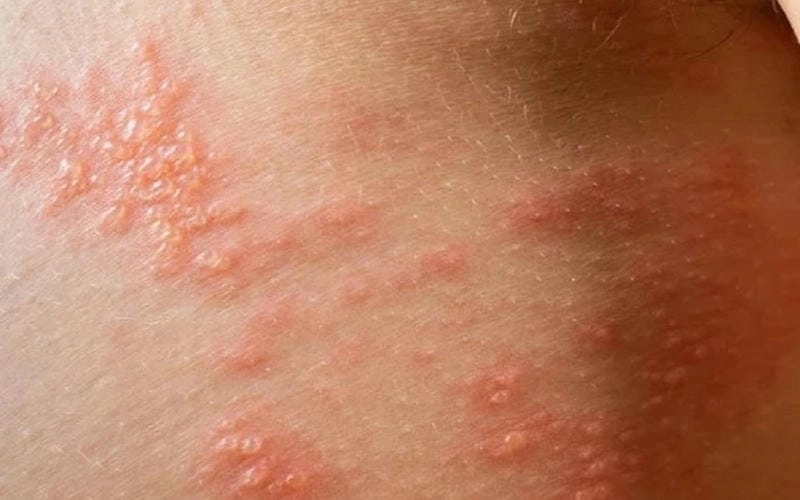 Zona ở trẻ em thường xuất hiện khi đề kháng yếu