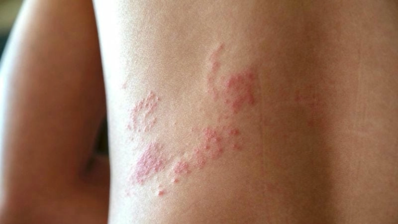 Zona trẻ em và các biểu hiện ngoài da điển hình