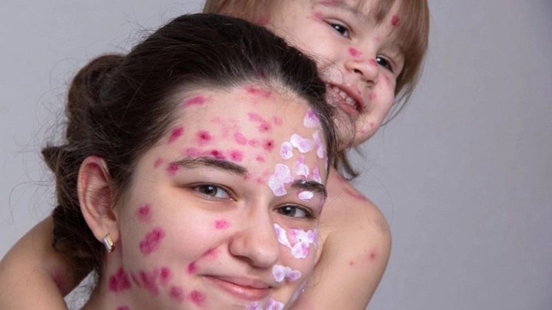 Trẻ em bị zona cần theo dõi và chăm sóc sớm