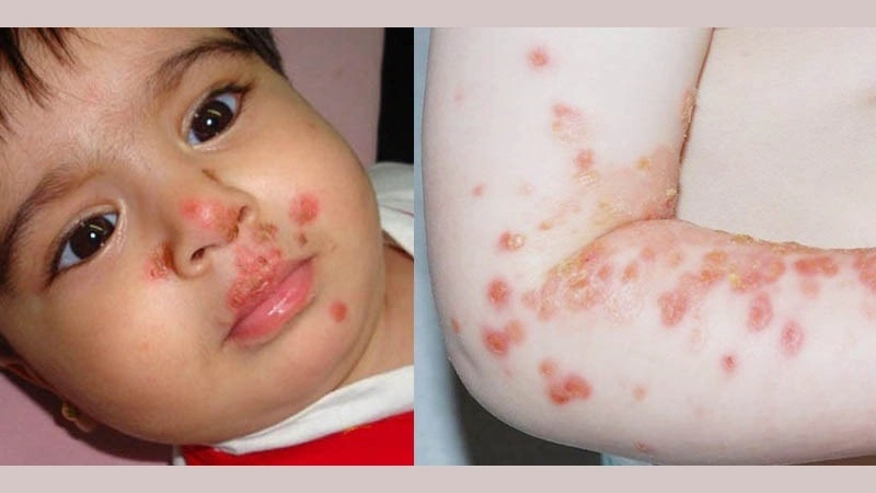 Tải ngay bộ ảnh zona ở trẻ em minh họa rõ nét chân thực