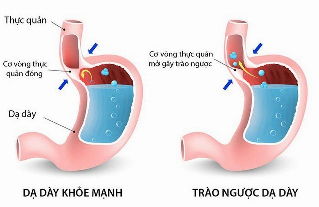 Tô màu tóm tắt nguyên nhân và triệu chứng trào ngược dạ dày