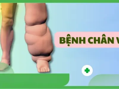 Hình ảnh bệnh phù chân voi và cách nhận biết sớm