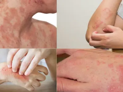 Hình ảnh bệnh nấm da phổ biến và cách nhận biết sớm
