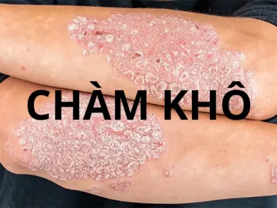 Nhận diện sớm qua hình ảnh bệnh chàm khô thường gặp