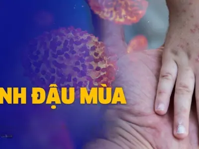 Hình ảnh bệnh đậu mùa ở người lớn và trẻ nhỏ dễ nhận biết
