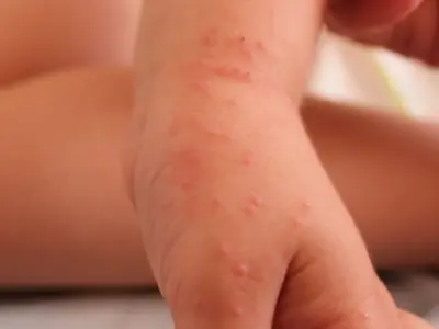 Hình ảnh bệnh ghẻ ngứa ở tay chân dễ nhận biết nhất