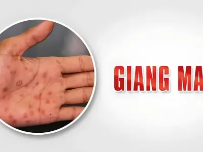 Hình ảnh bệnh giang mai ở nam và nữ qua từng giai đoạn