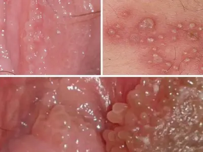 Tổng hợp hình ảnh bệnh sùi mào gà dễ nhận biết nhất