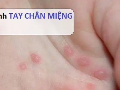 Hình ảnh bệnh tay chân miệng ở người lớn và trẻ nhỏ