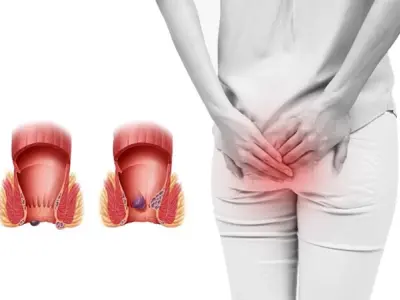 Nhận biết sớm qua hình ảnh bệnh trĩ thường gặp