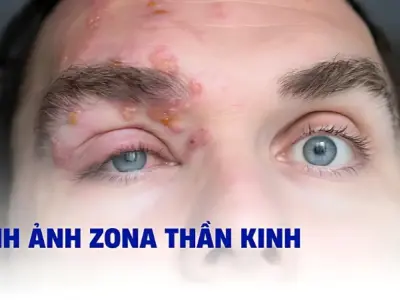 Hình ảnh bệnh zona thần kinh ở mắt và dấu hiệu nhận biết