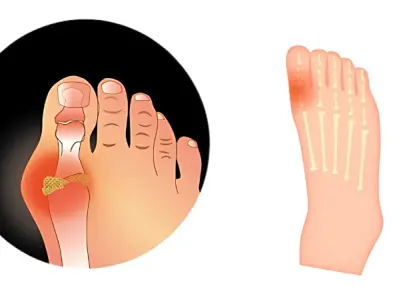 Cảnh báo sớm qua hình ảnh bệnh gout điển hình